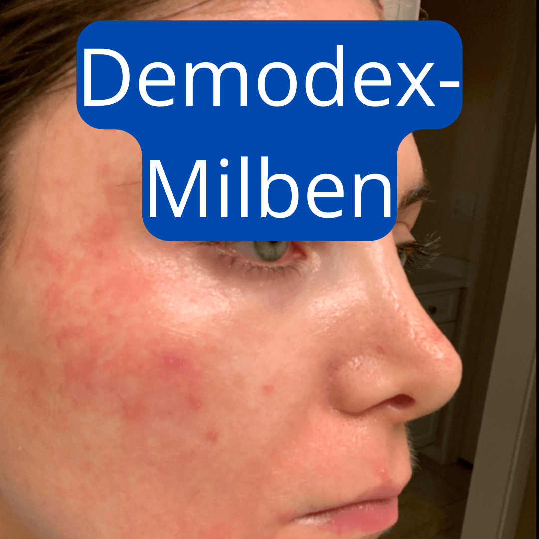 Frau mit rotem juckreizendem Hautausschlag im Gesicht durch Demodex Milben