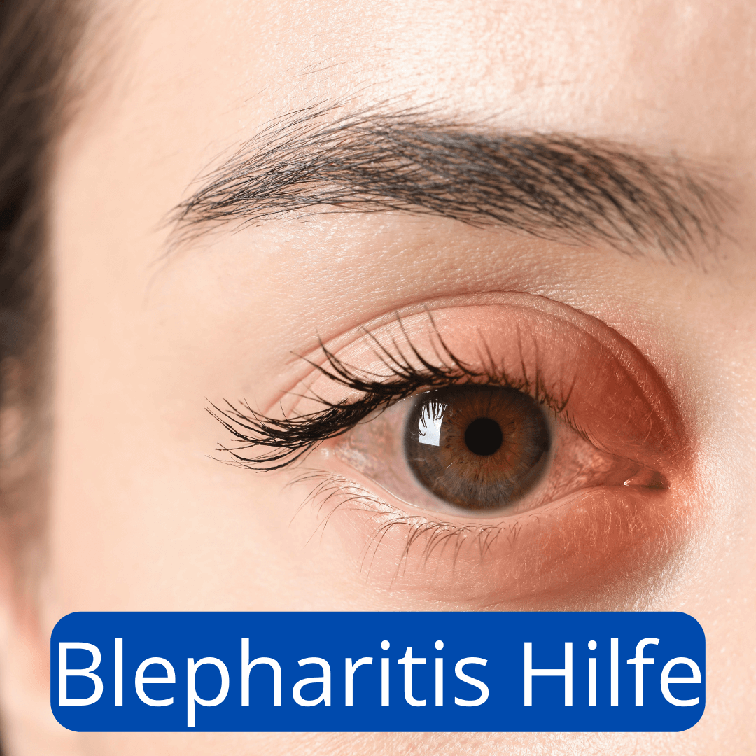 Blepharitis am Auge – geröteter Lidrand bei Lidrandentzündung