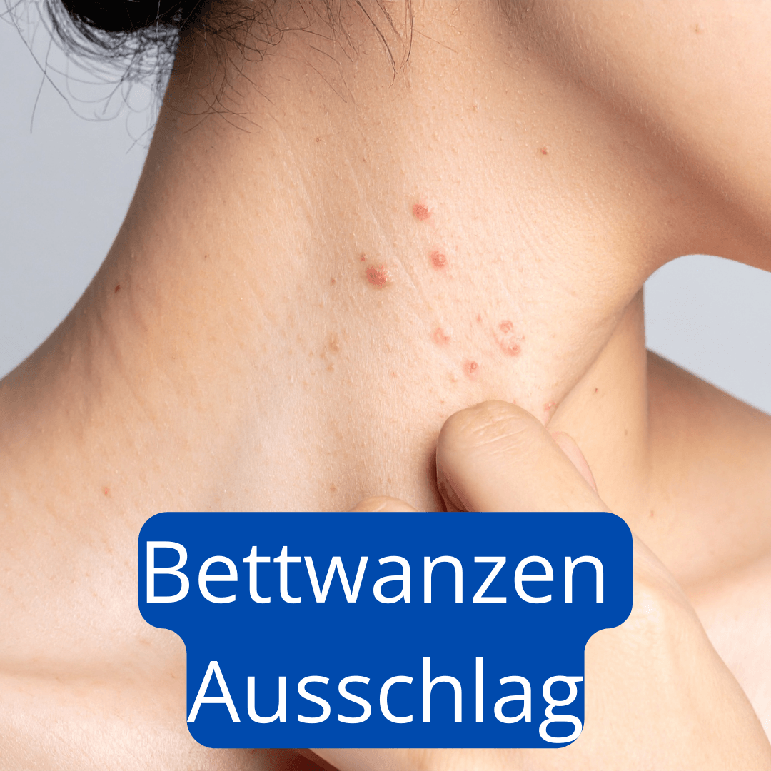 Bettwanzen Ausschlag am Hals