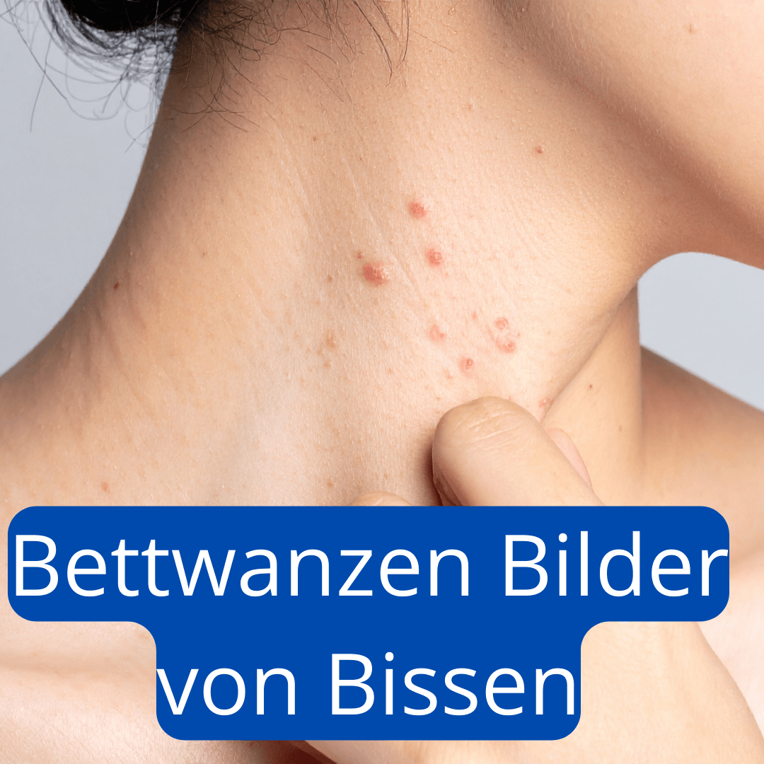 Bettwanzen Bilder von Bissen auf dem Hals einer Frau