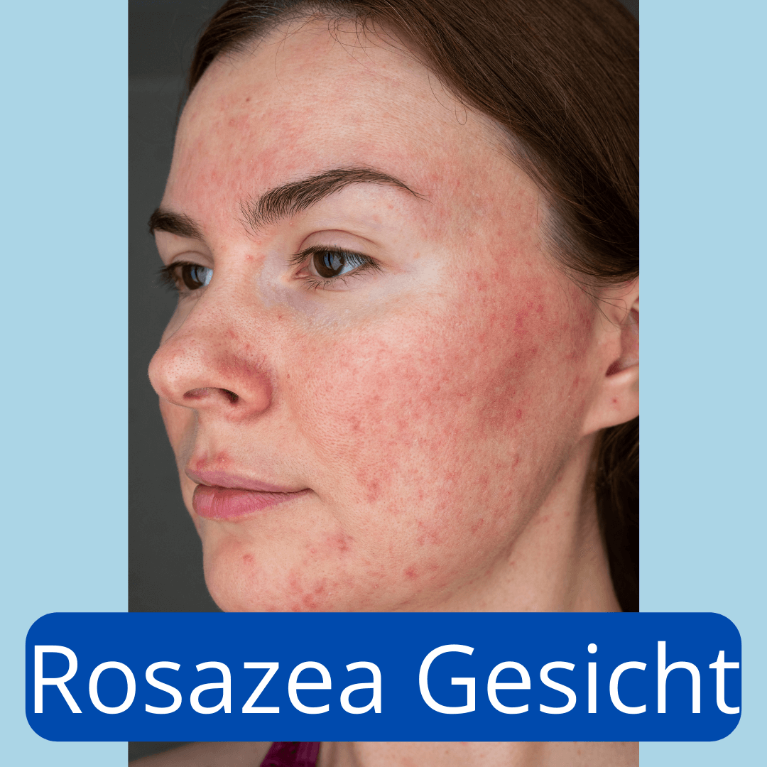 Frau mit gerötetem Gesicht und sichtbaren Papeln auf Wangen und Stirn – typische Anzeichen von Rosazea im Gesicht