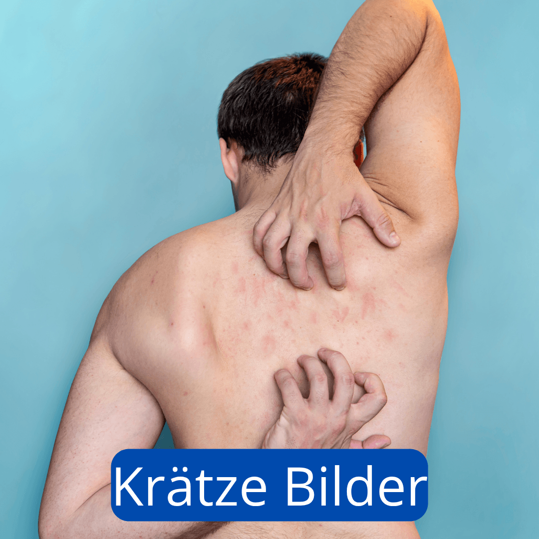 Mann mit Krätze auf dem Rücken kratzt sich