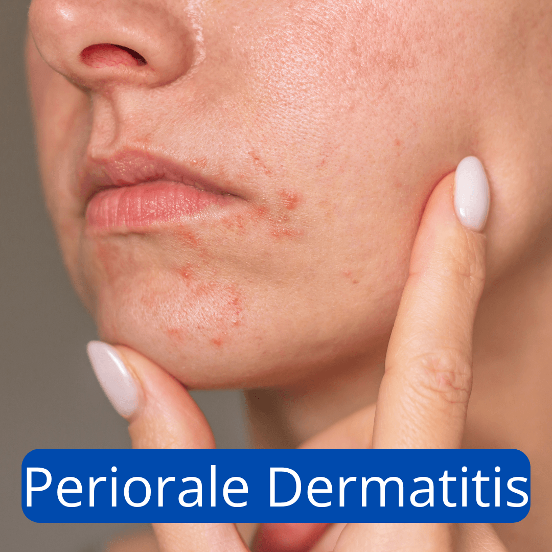 Periorale Dermatitis Mund
